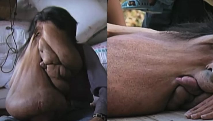 “Fil Adam”: Dünyanın en büyük yüz tümörüne sahip fil adamın hareket etmesi, yemek yemesi ve hatta uyuması bile zor